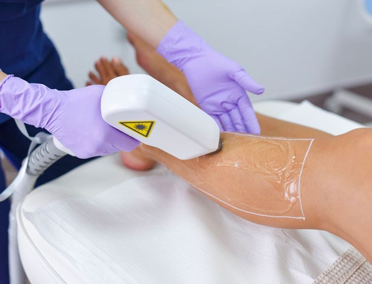 Epilare Laser